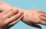 TPHCM: Phát hiện thêm một ca mắc đậu mùa khỉ ở huyện Bình Chánh