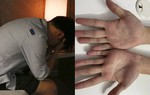 Sợ bị đậu mùa khỉ, nam thanh niên 26 tuổi đi khám mới phát hiện bệnh không ngờ
