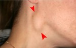 Đau họng nổi hạch ở cổ do đâu? Tình trạng này có nguy hiểm không?