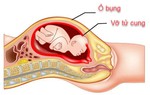 Cảnh báo vỡ tử cung trên bệnh nhân mổ đẻ cũ
