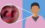 Lưỡi gà là gì? Lưỡi gà bị sưng là do đâu?