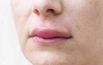 Phù mạch gây sưng môi, sưng mắt khi nào là nguy hiểm?
