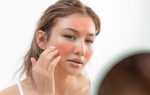Tại sao da thường bị nổi mẩn ngứa khi gặp gió? 10 biện pháp giúp giảm triệu chứng nhanh chóng