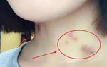 Con gái 13 tuổi có vết bầm tím ở cổ bị tra hỏi, câu trả lời khiến phụ huynh nhói lòng 