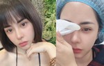 Bạn gái Huỳnh Anh công khai tiếp tục thẩm mỹ