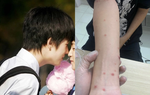 Bé 14 tuổi nhiễm HIV, giang mai, nghi sùi mào gà: Cảnh báo quan hệ tình dục sớm ở tuổi vị thành niên