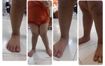Bàn chân bẹt: Chuyên gia tiết lộ thời điểm vàng mẹ cần cho con đi khám