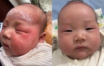 3 lỗi thường gặp khi chữa bệnh viêm da dầu cho trẻ nhỏ