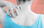 Các biện pháp giảm mụn lưng tự nhiên giúp chị em tự tin chào hè