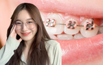 Ưu, nhược điểm của các phương pháp niềng răng hiện có