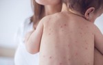 Bác sĩ chia sẻ 4 sai lầm bố mẹ rất hay mắc khi con bị thuỷ đậu khiến bệnh trầm trọng hơn