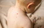 Con có những dấu hiệu này mẹ cần cho con đi khám gấp vì nguy cơ bị thủy đậu