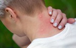 Cách phân biệt các vết đốt của côn trùng