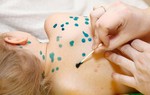 "3 nên, 5 kiêng" khi con bị thủy đậu để bé mau khỏi, không biến chứng