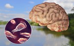 Những điều cần biết về amip ăn não người 