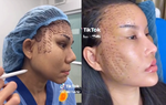 Kiểu căng da "mặt rắn" đang rầm rộ trên Tiktok, sự thật phía sau được bác sĩ giải đáp