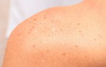 Tìm hiểu về tình trạng đốm trắng trên da do ánh nắng mặt trời