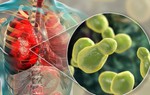 Các loại nấm gây viêm phổi và cách phòng ngừa