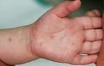 Tay chân miệng gia tăng tại Hà Nội: Phòng tránh thế nào?