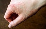 Cách phân biệt mụn nhọt, mẩn ngứa do nhiệt và do suy giảm chức năng gan