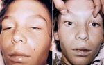 Từ vụ 3 bệnh nhi ngộ độc botulinum, có dấu hiệu này cần đưa đến bệnh viện ngay