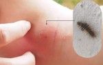 Phát ban do sâu bướm: Cách phát hiện và điều trị