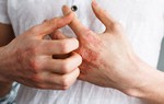2 bệnh nhân mắc giang mai ác tính hiếm gặp do quan hệ đồng giới