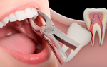 Cô gái 23 tuổi tử vong sau nhổ răng khôn: Bác sĩ chỉ ra những lưu ý tránh biến chứng nguy hiểm