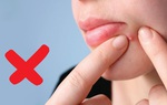 3 biến chứng đáng sợ khi nặn mụn không đúng cách