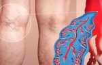 4 dấu hiệu cảnh báo cục máu đông trong cơ thể