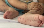 Nhiều trẻ mắc tay chân miệng trở nặng: Chuyên gia dự đoán số ca sẽ tăng cao