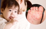 Bác sĩ nhi hướng dẫn cách tự theo dõi và chăm sóc con bị tay chân miệng tại nhà