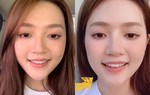 An Vy chia sẻ bị liệt dây thần kinh một bên mặt, cười nói khó khăn 