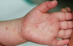 Mẹ tự điều trị tay chân miệng cho con suýt gây hậu quả nghiêm trọng 
