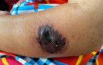 Nguy cơ lây lan bệnh than từ gia súc: Bác sĩ chỉ cách phòng tránh 
