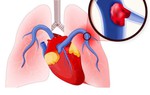 Tắc động mạch phổi - "kẻ giết người thầm lặng"