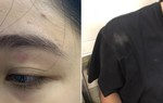 Cô gái bị nhân viên quán bánh mì ở Hà Nội đánh: "Đến hôm nay tôi vẫn còn khá sốc"