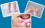 Những dấu hiệu khỏi bệnh tay chân miệng và cách chăm sóc trẻ sau khi khỏi bệnh