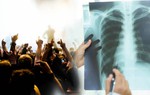Thanh niên vỡ phế nang vì la hét trong concert của thần tượng: Nguyên nhân nào dẫn đến tràn khí màng phổi?