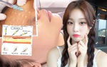 Bác sĩ da liễu lý giải vì sao tiêm meso "gây sốt" trong thẩm mỹ nội khoa
