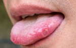 4 "thủ phạm" gây ra ung thư lưỡi, nhiều người Việt vẫn đang duy trì
