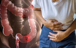 Ung thư ruột giai đoạn đầu thường có 3 tín hiệu dễ nhầm lẫn