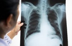 6 nhóm người dễ mắc ung thư phổi hơn bất cứ ai