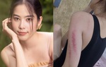 Nam Em gây lo lắng khi để lộ cánh tay đỏ bầm kèm chia sẻ đầy tâm trạng