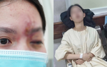 Tình trạng sức khỏe hiện tại của nữ sinh 17 tuổi bị mù mắt vì tiêm filler ở tiệm cắt tóc, gội đầu