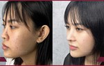 Thay đổi dáng mũi là thay đổi cả khuôn mặt, bạn tin không? 