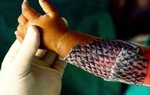 Da cá giúp điều trị bỏng và vết thương mãn tính