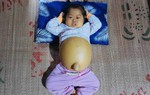 Lặng người khi nhìn bé gái 2 tuổi với cái bụng như chực "nổ tung"