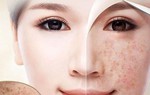 Trị nám bằng 12 nguyên liệu có trong căn bếp gia đình