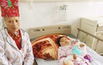 Cấp cứu bệnh nhi 3 tuổi bị bỏng do luộc bánh chưng